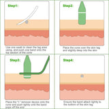 Skin Tag Remover Kit For Home Use - lockandclock