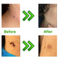 Skin Tag Remover Kit For Home Use - lockandclock