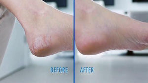 Electric Pedivac-Remove Your Callus Easily - lockandclock